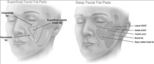 lipofilling facial