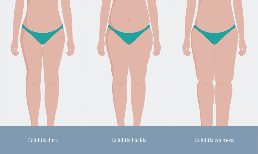 AGB Graficos Celulitis Tipos