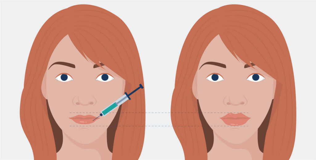 AGB Graficos Aumento Labios