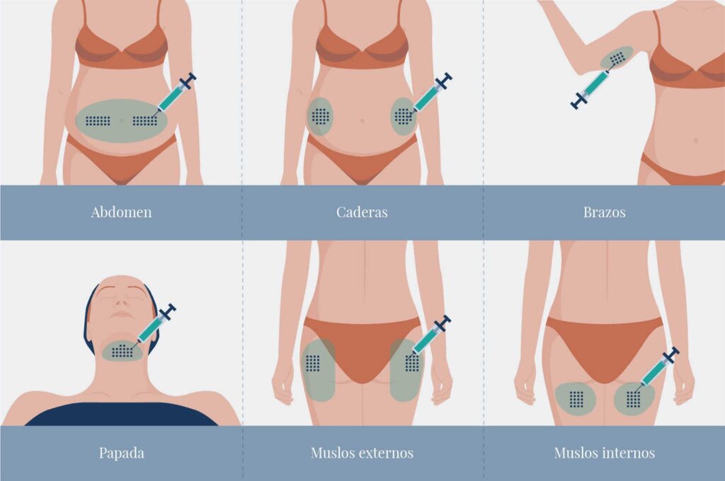 AGB Graficos Intralipoterapia 1