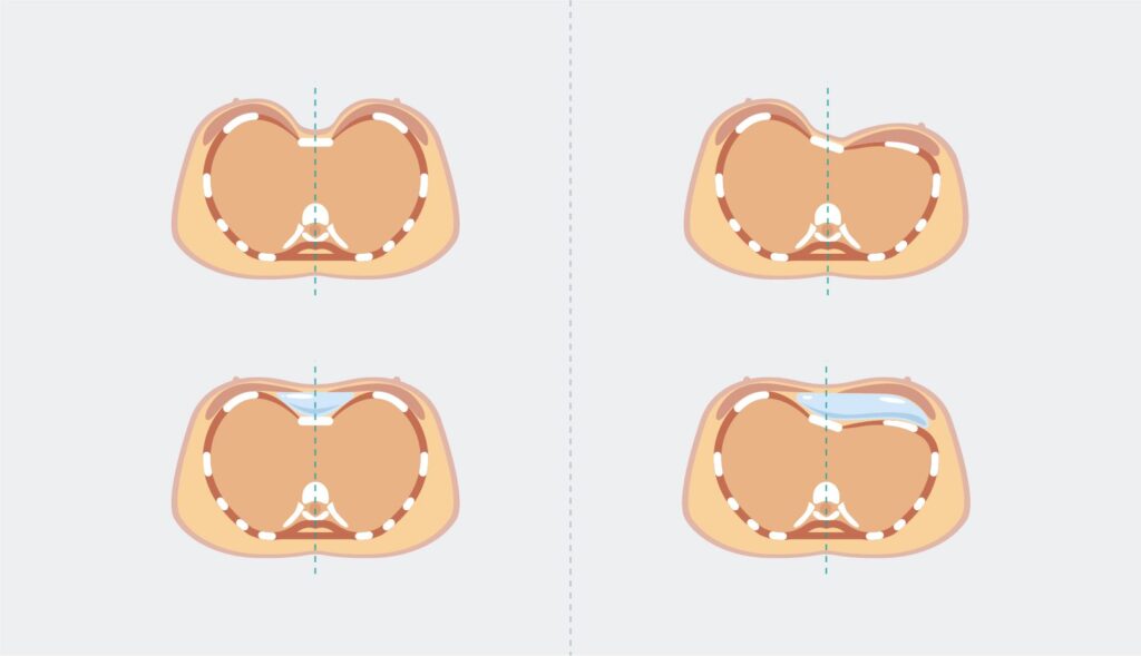 AGB Graficos Pectus Excavatum 1