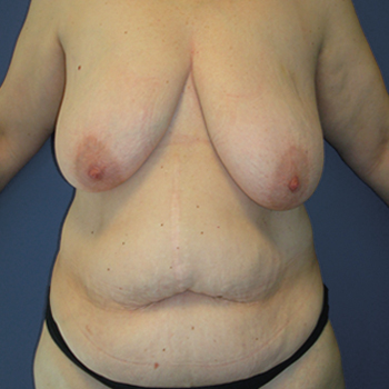 antes y despues abdominoplastia 03 a