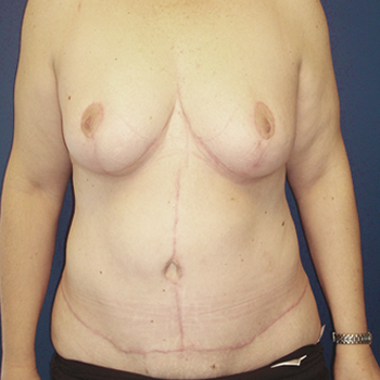 antes y despues abdominoplastia 03 d