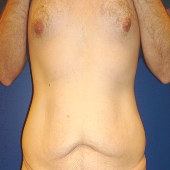 antes y despues abdominoplastia 04 a 1