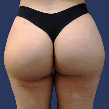 antes y despues aumento gluteos 01 d