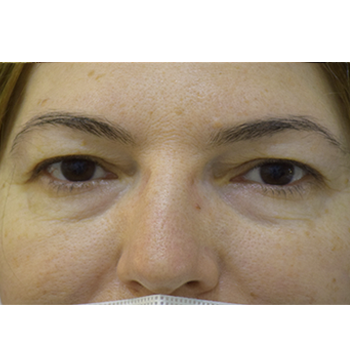 antes y despues blefaroplastia 01 a