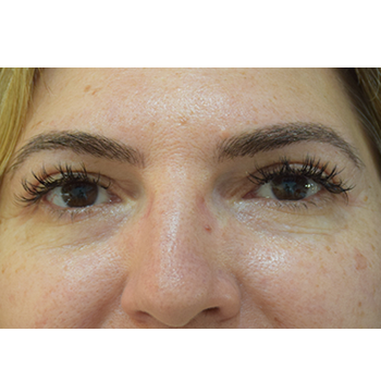 antes y despues blefaroplastia 01 d