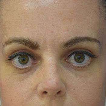 antes y despues blefaroplastia 03 d