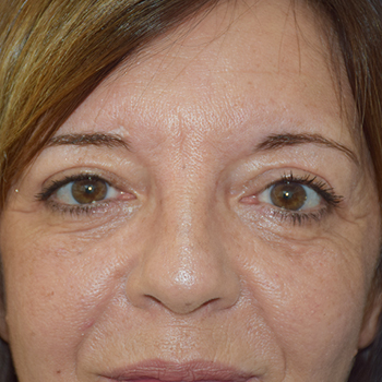 antes y despues blefaroplastia d