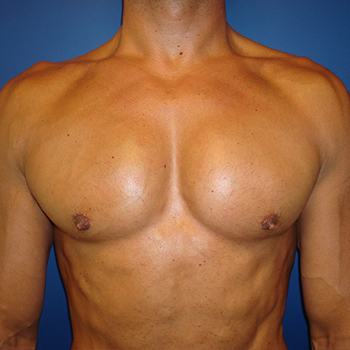 antes y despues implante pectoral 01 d