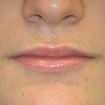 antes y despues aumento labios 03
