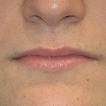 antes y despues aumento labios 04