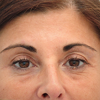 antes y despues botox 07