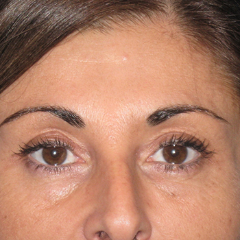 antes y despues botox 08