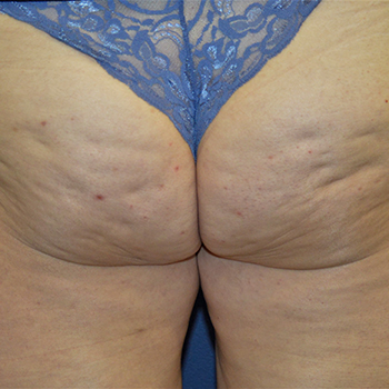 antes y despues celulitis 013