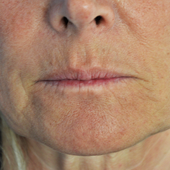 antes y despues skin booster