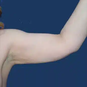 liposuccion de brazo