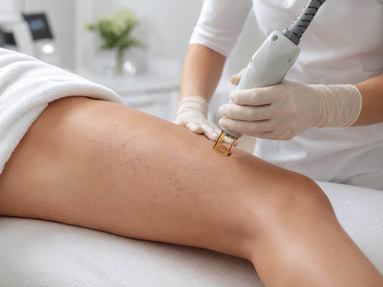 tratamiento laser vascular